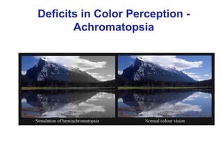 Deficits in Color Perception -
Achromatopsia
 