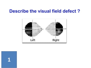 Describe the visual field defect ?
1
 