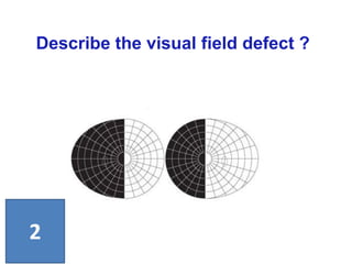 Describe the visual field defect ?
2
 