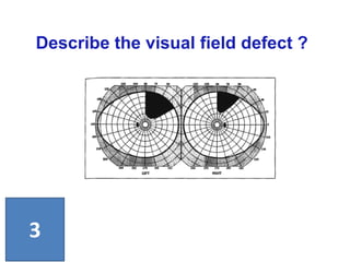 Describe the visual field defect ?
3
 