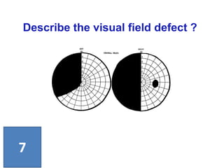 Describe the visual field defect ?
7
 
