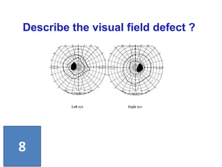 Describe the visual field defect ?
8
 