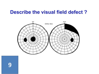 Describe the visual field defect ?
9
 