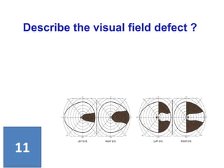 Describe the visual field defect ?
11
 