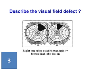 Right superior quadrantanopia >>
temoporal lobe lesion
Describe the visual field defect ?
3
 