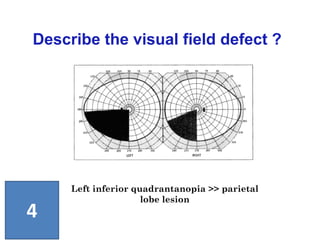 Left inferior quadrantanopia >> parietal
lobe lesion
Describe the visual field defect ?
4
 