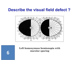 Left homonymous hemianopia with
macular sparing
Describe the visual field defect ?
6
 