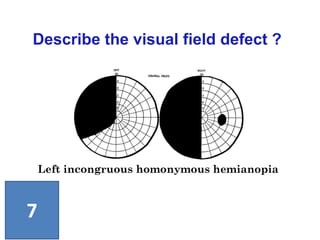 Left incongruous homonymous hemianopia
Describe the visual field defect ?
7
 