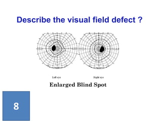 Enlarged Blind Spot
Describe the visual field defect ?
8
 