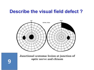 Describe the visual field defect ?
Junctional scotoma: lesion at junction of
optic nerve and chiasm
9
 