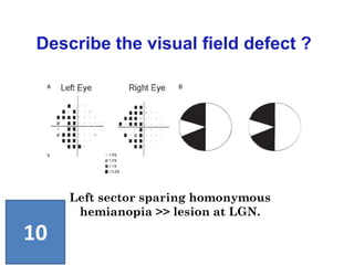 Left sector sparing homonymous
hemianopia >> lesion at LGN.
Describe the visual field defect ?
10
 