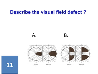 Describe the visual field defect ?
11
A. B.
 