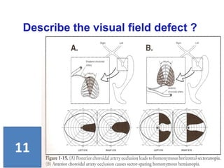 Describe the visual field defect ?
11
 