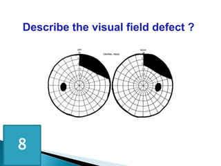 Describe the visual field defect ?
8
 