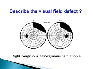 Right congruous homonymous hemianopia
Describe the visual field defect ?
 
