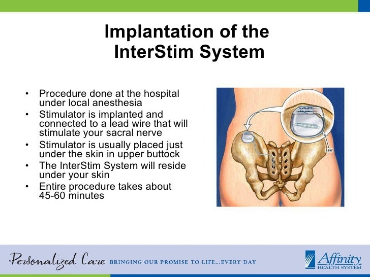 bladder stimulator implant bladder stimulator implant