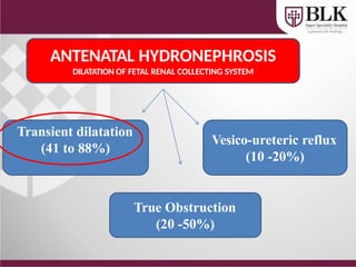 Hydronephrosis in Child Treatment Delhi: Expert Pediatric Care | PPTX