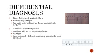 Inverted A Flutter ED approach to atrial fibrillation.pptx