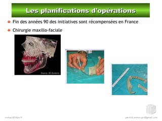 Les planifications d'opérationsLes planifications d'opérations
Fin des années 90 des initiatives sont récompensées en France
Chirurgie maxillo-faciale
Source: 3D Systems
 
