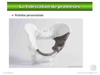 La fabrication de prothèsesLa fabrication de prothèses
Prothèse personnalisée
Source Alphaform GmbH
 
