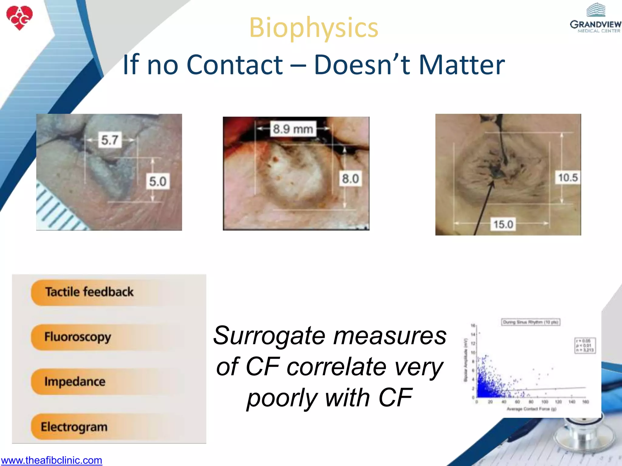 Biophysics
If no Contact – Doesn’t Matter
Surrogate measures
of CF correlate very
poorly with CF
www.theafibclinic.com
 