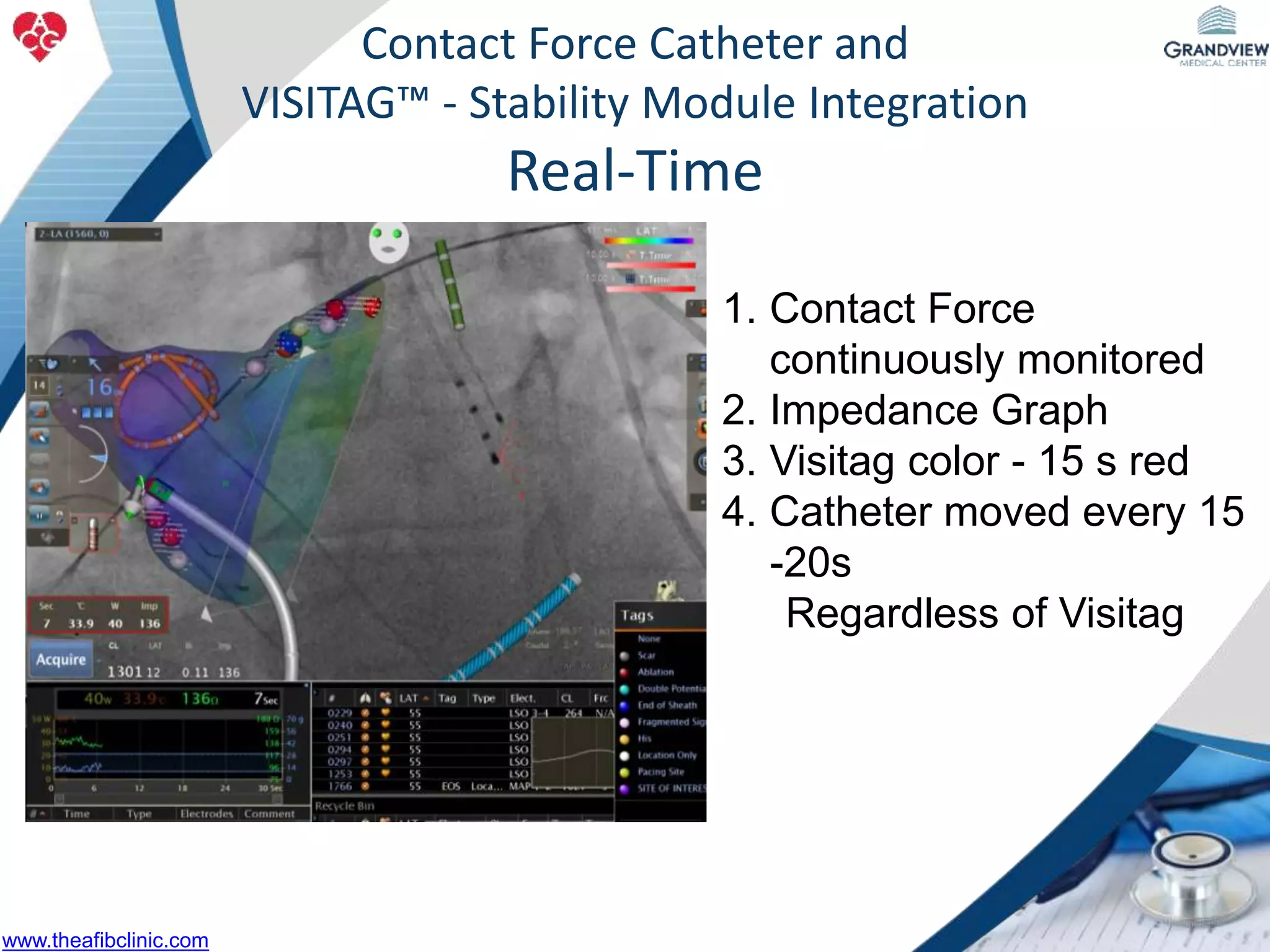 1. Contact Force
continuously monitored
2. Impedance Graph
3. Visitag color - 15 s red
4. Catheter moved every 15
-20s
Regardless of Visitag
Contact Force Catheter and
VISITAG™ - Stability Module Integration
Real-Time
www.theafibclinic.com
 