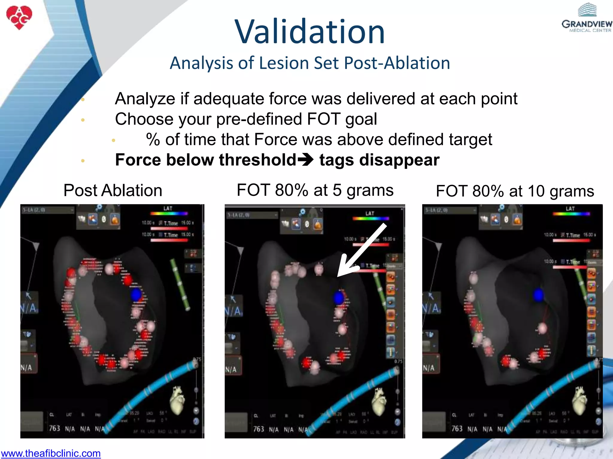 FOT 80% at 5 grams FOT 80% at 10 gramsPost Ablation
• Analyze if adequate force was delivered at each point
• Choose your pre-defined FOT goal
• % of time that Force was above defined target
• Force below threshold tags disappear
Validation
Analysis of Lesion Set Post-Ablation
www.theafibclinic.com
 