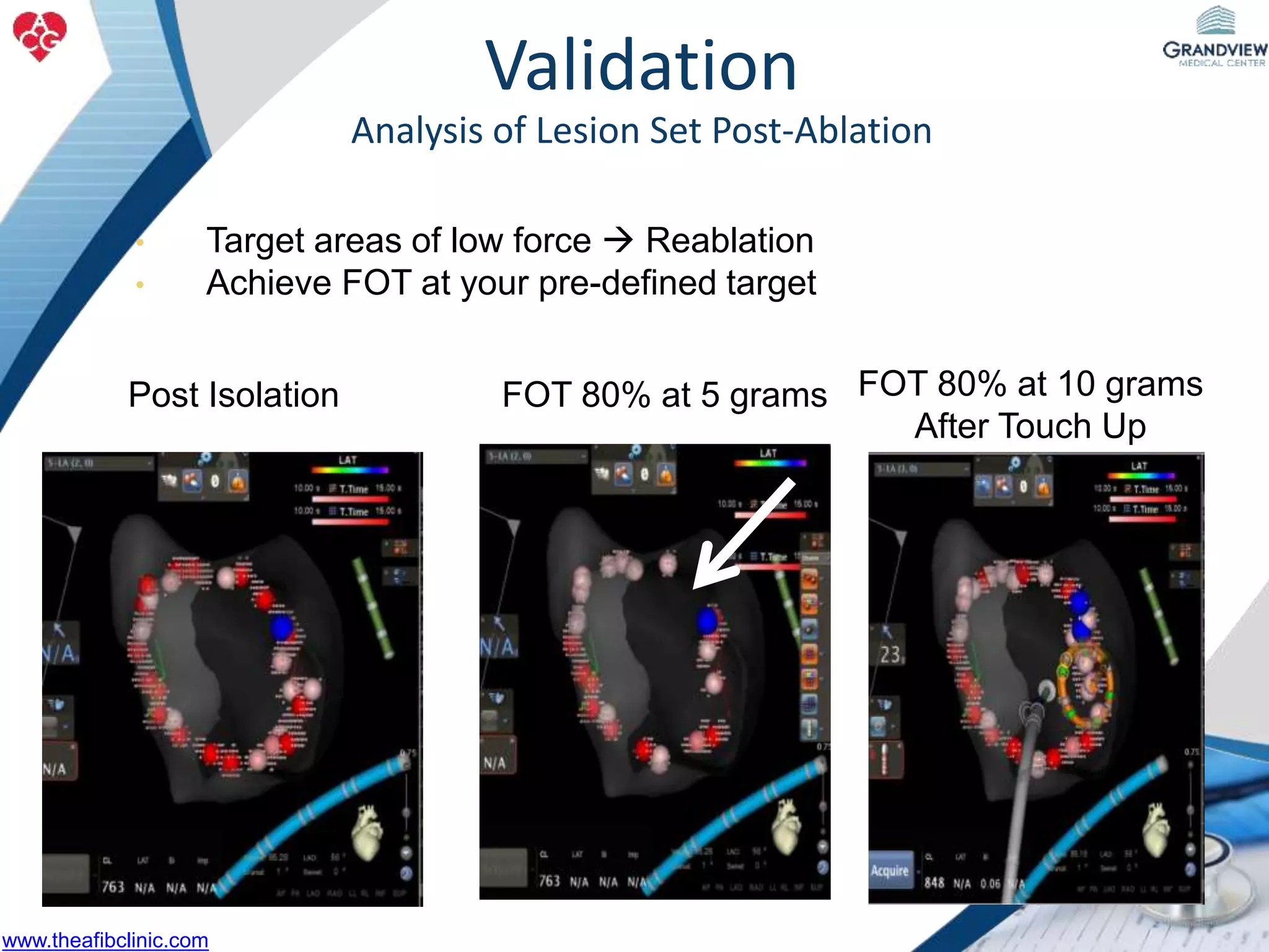 • Target areas of low force  Reablation
• Achieve FOT at your pre-defined target
FOT 80% at 5 grams FOT 80% at 10 grams
After Touch Up
Post Isolation
Validation
Analysis of Lesion Set Post-Ablation
www.theafibclinic.com
 