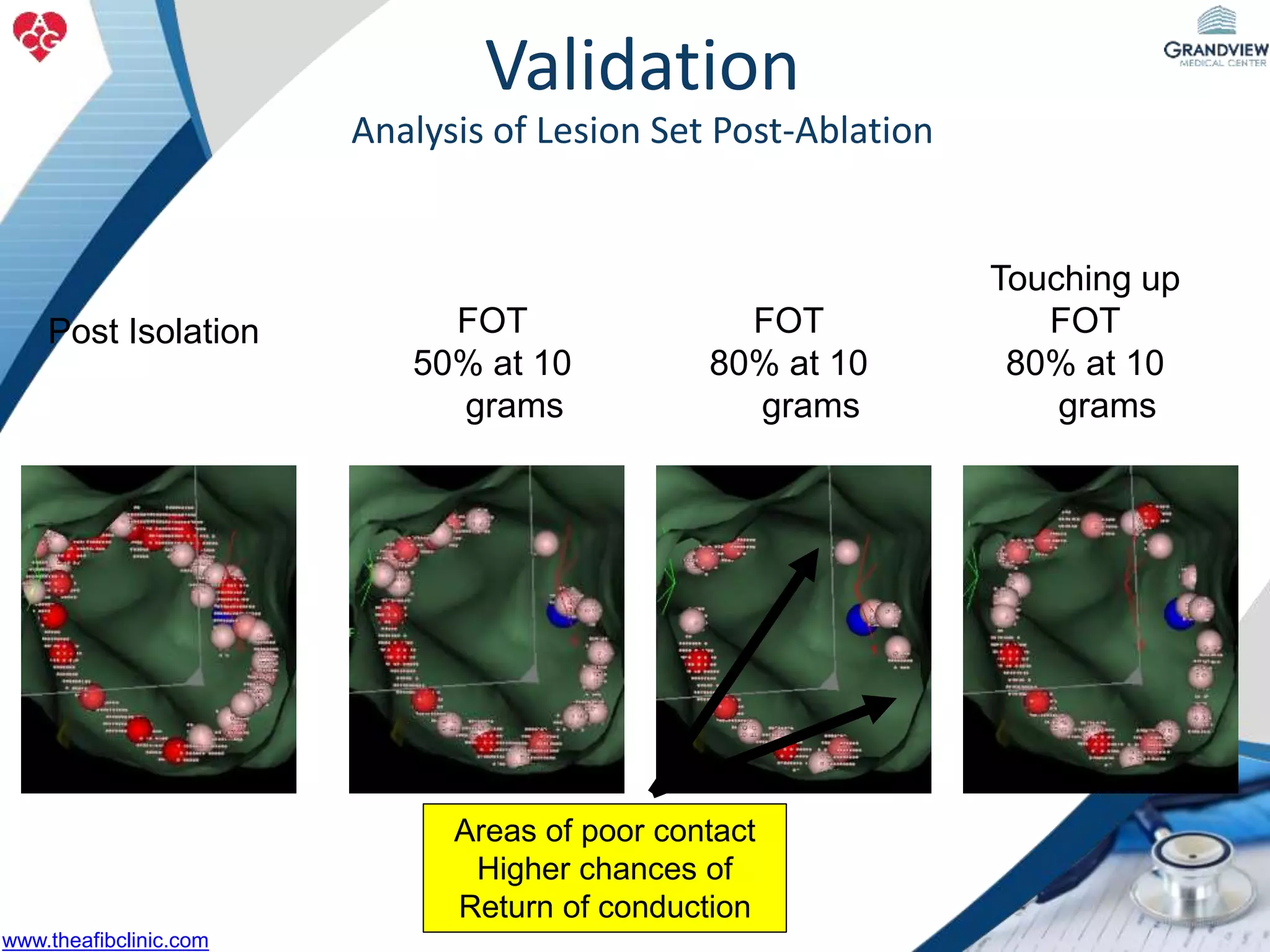 FOT
50% at 10
grams
Post Isolation
Touching up
FOT
80% at 10
grams
FOT
80% at 10
grams
Areas of poor contact
Higher chances of
Return of conduction
Validation
Analysis of Lesion Set Post-Ablation
www.theafibclinic.com
 