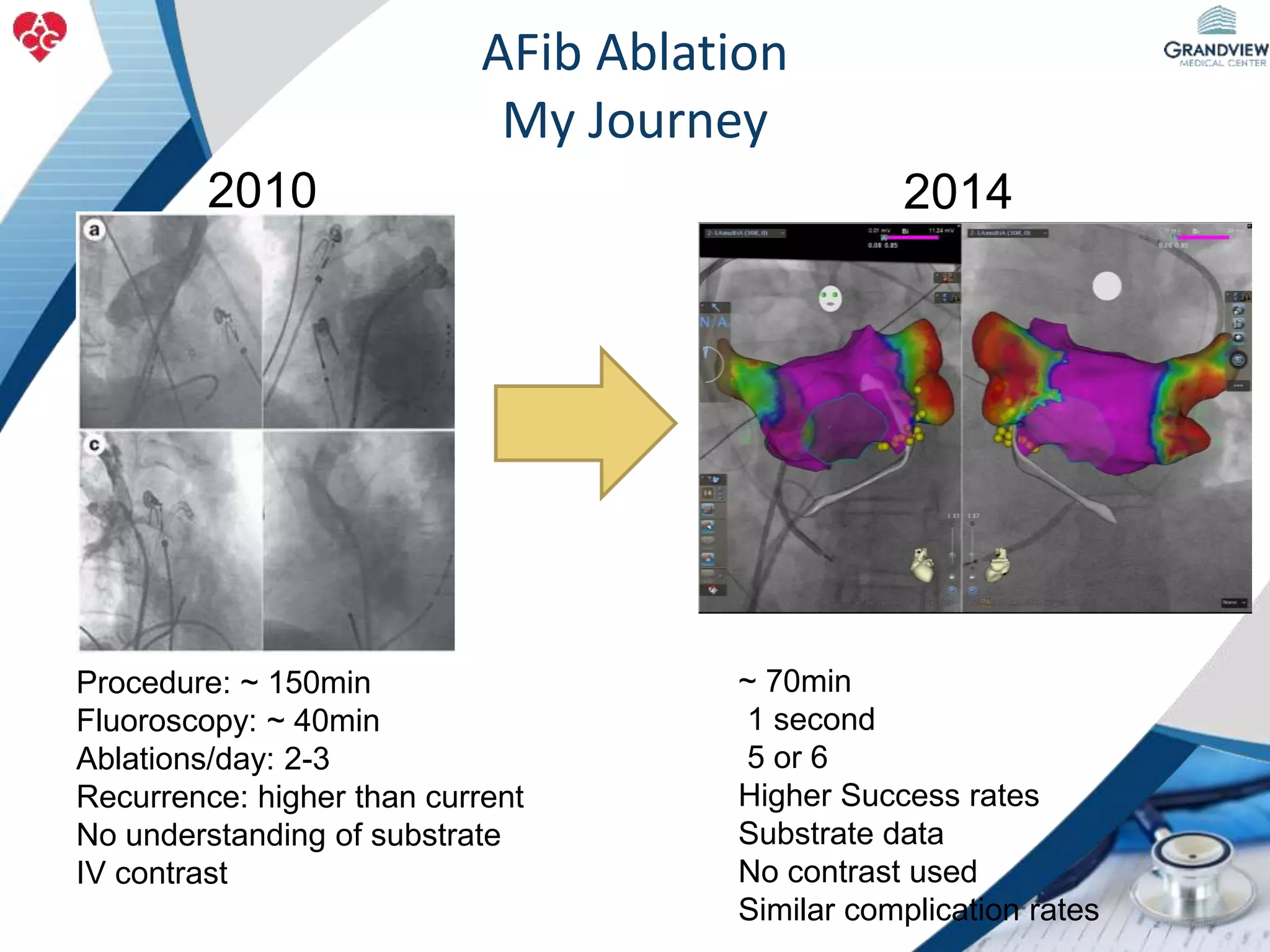 AFib Ablation
My Journey
Procedure: ~ 150min
Fluoroscopy: ~ 40min
Ablations/day: 2-3
Recurrence: higher than current
No understanding of substrate
IV contrast
2010
~ 70min
1 second
5 or 6
Higher Success rates
Substrate data
No contrast used
Similar complication rates
2014
 