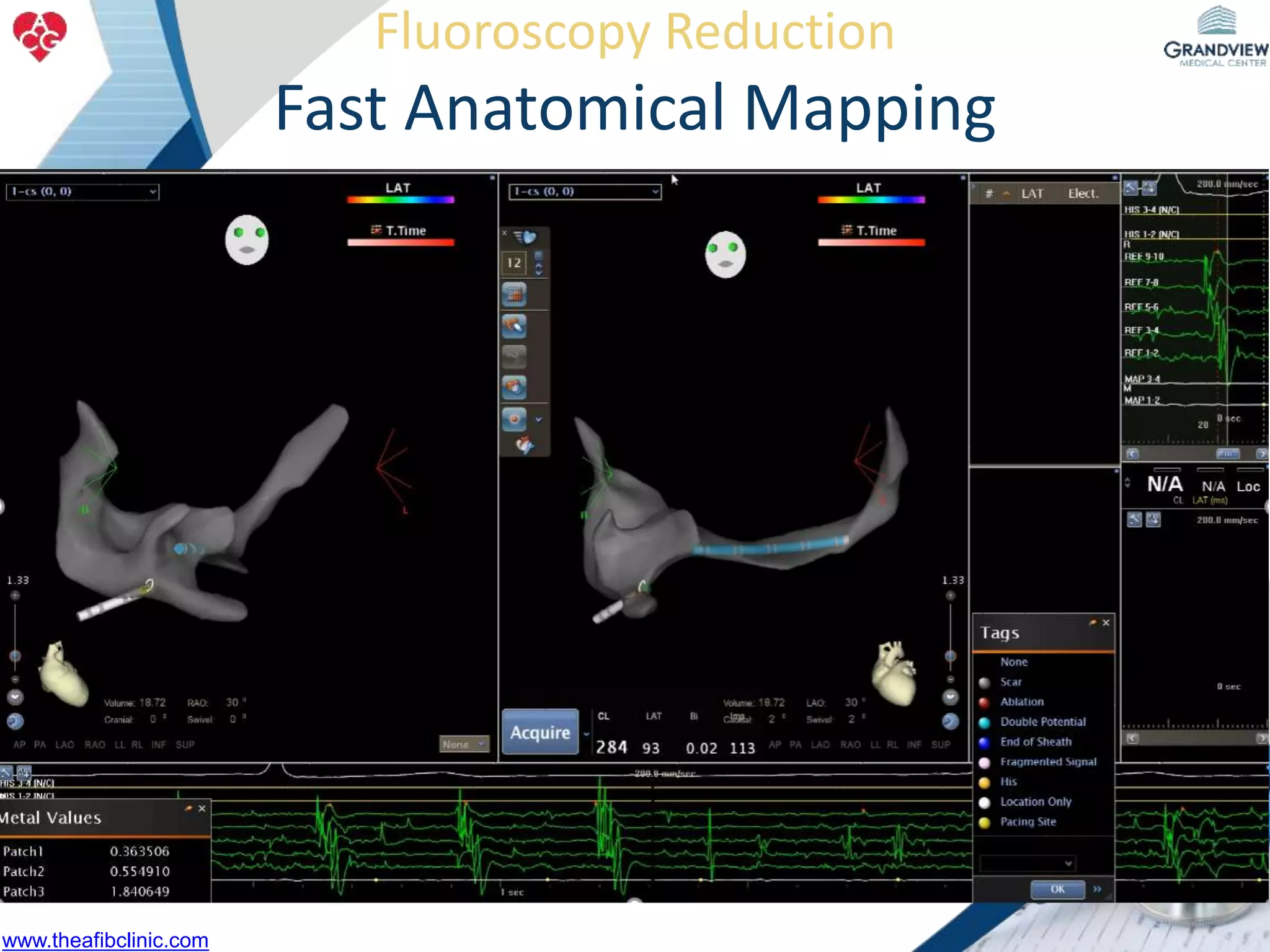 Fluoroscopy Reduction
Fast Anatomical Mapping
www.theafibclinic.com
 