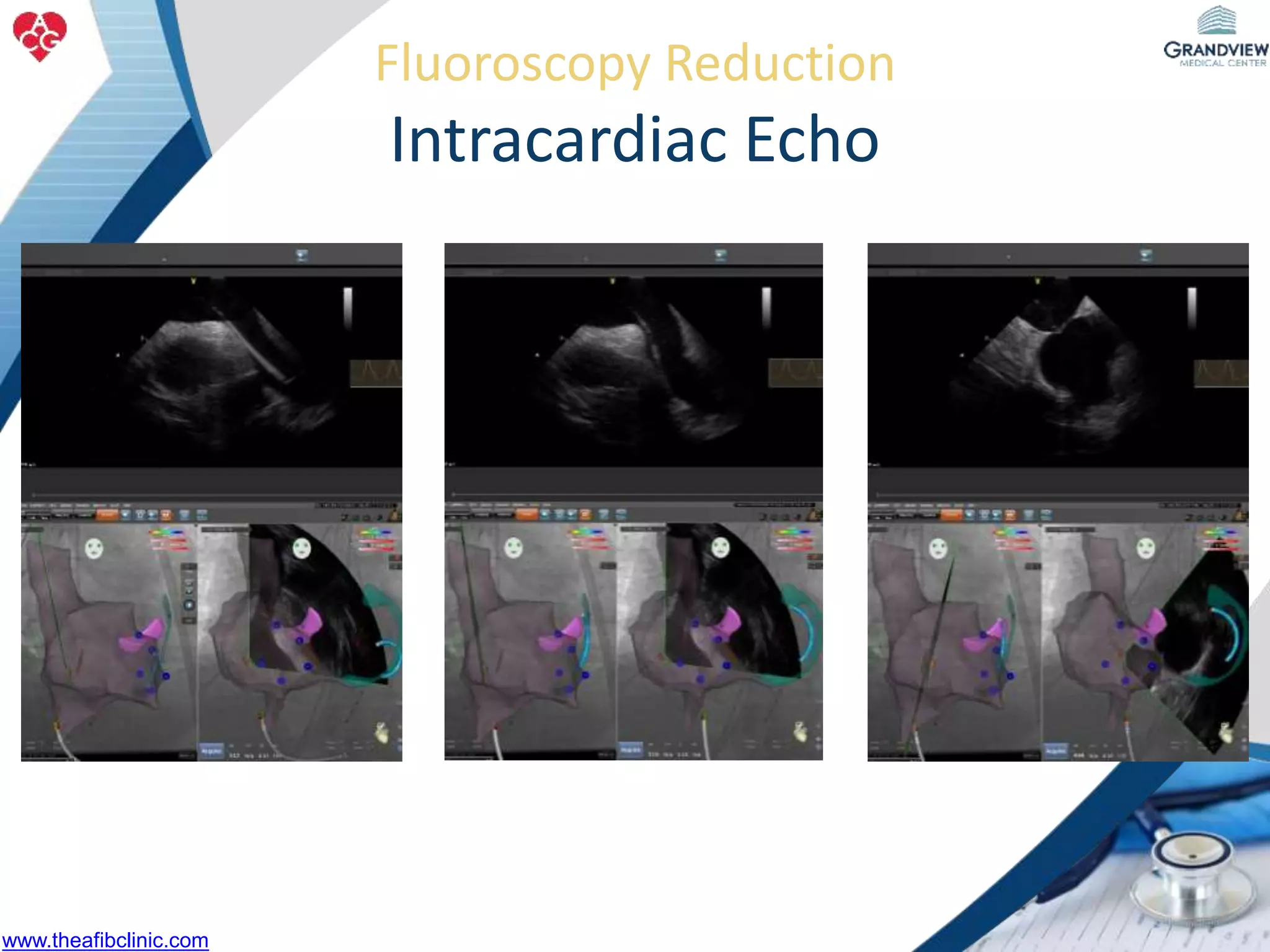 Fluoroscopy Reduction
Intracardiac Echo
www.theafibclinic.com
 