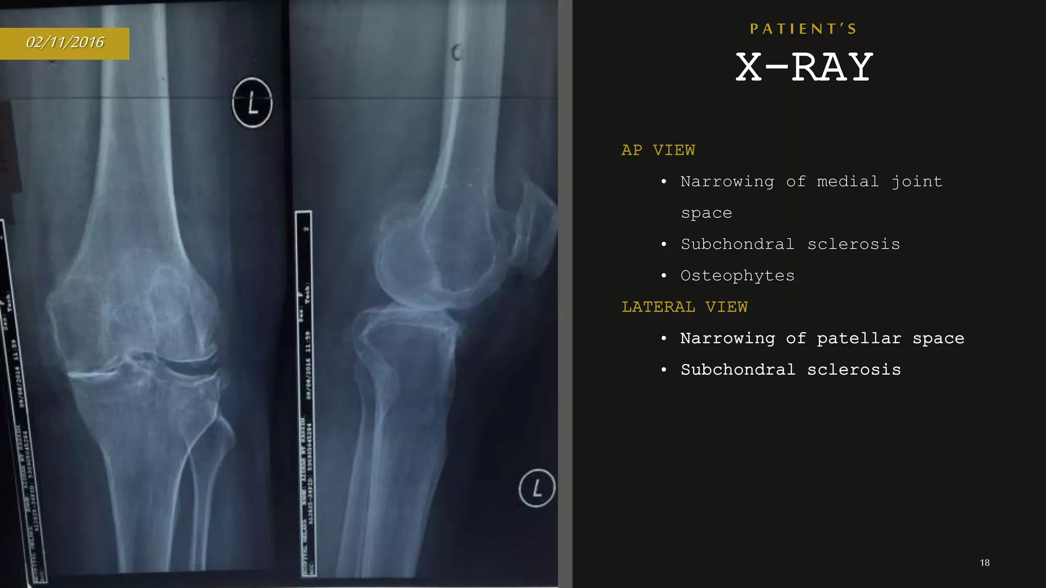 P A T I E N T ’ S
X-RAY
18
02/11/2016
AP VIEW
• Narrowing of medial joint
space
• Subchondral sclerosis
• Osteophytes
LATERAL VIEW
• Narrowing of patellar space
• Subchondral sclerosis
 