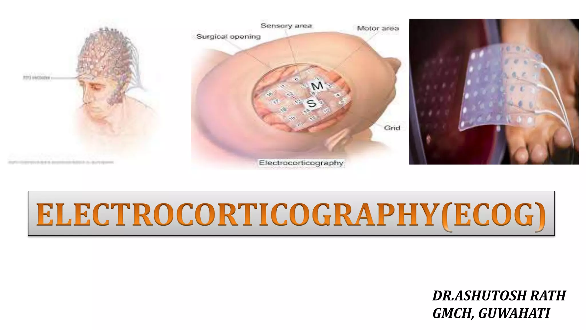 Ecogram Definition ELECTROCORTICOGRAPHY(ECOG) | PPTX
