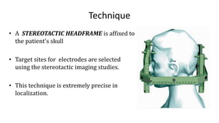 Technique
• A STEREOTACTIC HEADFRAME is affixed to
the patient's skull
• Target sites for electrodes are selected
using the stereotactic imaging studies.
• This technique is extremely precise in
localization.
 