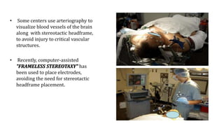 • Some centers use arteriography to
visualize blood vessels of the brain
along with stereotactic headframe,
to avoid injury to critical vascular
structures.
• Recently, computer-assisted
"FRAMELESS STEREOTAXY" has
been used to place electrodes,
avoiding the need for stereotactic
headframe placement.
 