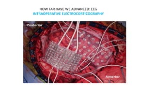 HOW FAR HAVE WE ADVANCED: EEG
INTRAOPERATIVE ELECTROCORTICOGRAPHY
 