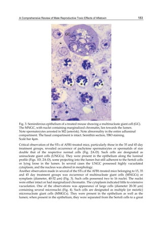 A Comprehensive Review of Male Reproductive Toxic Effects of Aflatoxin 
183 
Fig. 3. Seminiferous epithelium of a treated mouse showing a multinucleate giant cell (GC). 
The MNGC, with nuclei containing marginalized chromatin, lies towards the lumen. 
Note spermatocytes arrested in M2 (asterisk). Note abnormality in the entire adluminal 
compartment. The basal compartment is intact. Semithin section, TBO staining. 
Scale bar 4μm. 
Critical observation of the STs of AFB1-treated mice, particularly those in the 35 and 45 day 
treatment groups, revealed occurrence of pachytene spermatocytes or spermatids of size 
double that of the respective normal cells (Fig. 2A-D). Such cells are designated as 
uninucleate giant cells (UNGCs). They were present in the epithelium along the luminal 
profile (Figs. 1D, 2A-D), some projecting into the lumen but still adherent to the Sertoli cells 
or lying loose in the lumen. In several cases the UNGC possessed highly vacuolated 
cytoplasm, and the nucleus was altered in morphology. 
Another observation made in several of the STs of the AFB1-treated mice belonging to 15, 35 
and 45 day treatment groups was occurrence of multinucleate giant cells (MNGCs) or 
symplasts (diameter, 40-52 μm) (Fig. 3). Such cells possessed two to 16 nuclei. The nuclei 
were either intact or had marginalized chromatin. The cytoplasm indicated little to extensive 
vacuolation. One of the observations was appearance of large cells (diameter 20-30 μm) 
containing several micronuclei (Fig. 4). Such cells are designated as multiple (or meiotic) 
micronucleate giant cells (MMGCs). They were present in the epithelium as well as the 
lumen; when present in the epithelium, they were separated from the Sertoli cells to a great 
 