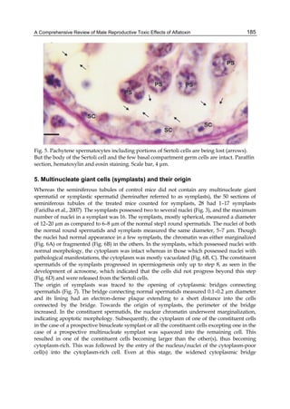 A Comprehensive Review of Male Reproductive Toxic Effects of Aflatoxin 
185 
Fig. 5. Pachytene spermatocytes including portions of Sertoli cells are being lost (arrows). 
But the body of the Sertoli cell and the few basal compartment germ cells are intact. Paraffin 
section, hematoxylin and eosin staining. Scale bar, 4 μm. 
5. Multinucleate giant cells (symplasts) and their origin 
Whereas the seminiferous tubules of control mice did not contain any multinucleate giant 
spermatid or symplastic spermatid (hereinafter referred to as symplasts), the 50 sections of 
seminiferous tubules of the treated mice counted for symplasts, 28 had 1–17 symplasts 
(Faridha et al., 2007). The symplasts possessed two to several nuclei (Fig. 3), and the maximum 
number of nuclei in a symplast was 16. The symplasts, mostly spherical, measured a diameter 
of 12–20 μm as compared to 6–8 μm of the normal step1 round spermatids. The nuclei of both 
the normal round spermatids and symplasts measured the same diameter, 5–7 μm. Though 
the nuclei had normal appearance in a few symplasts, the chromatin was either marginalized 
(Fig. 6A) or fragmented (Fig. 6B) in the others. In the symplasts, which possessed nuclei with 
normal morphology, the cytoplasm was intact whereas in those which possessed nuclei with 
pathological manifestations, the cytoplasm was mostly vacuolated (Fig. 6B, C). The constituent 
spermatids of the symplasts progressed in spermiogenesis only up to step 8, as seen in the 
development of acrosome, which indicated that the cells did not progress beyond this step 
(Fig. 6D) and were released from the Sertoli cells. 
The origin of symplasts was traced to the opening of cytoplasmic bridges connecting 
spermatids (Fig. 7). The bridge connecting normal spermatids measured 0.1–0.2 μm diameter 
and its lining had an electron-dense plaque extending to a short distance into the cells 
connected by the bridge. Towards the origin of symplasts, the perimeter of the bridge 
increased. In the constituent spermatids, the nuclear chromatin underwent marginalization, 
indicating apoptotic morphology. Subsequently, the cytoplasm of one of the constituent cells 
in the case of a prospective binucleate symplast or all the constituent cells excepting one in the 
case of a prospective multinucleate symplast was squeezed into the remaining cell. This 
resulted in one of the constituent cells becoming larger than the other(s), thus becoming 
cytoplasm-rich. This was followed by the entry of the nucleus/nuclei of the cytoplasm-poor 
cell(s) into the cytoplasm-rich cell. Even at this stage, the widened cytoplasmic bridge 
 