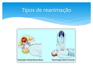 Tipos de reanimação

 