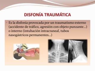 DISFONÍA TRAUMÁTICA
 Es la disfonía provocada por un traumatismo externo
(accidente de tráfico, agresión con objeto punzante…)
o interno (intubación intracraneal, tubos
nasogástricos permanentes…)
 