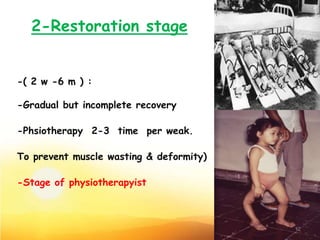 2-Restoration stage
-( 2 w -6 m ) :
-Gradual but incomplete recovery
-Phsiotherapy 2-3 time per weak.
To prevent muscle wasting & deformity)
-Stage of physiotherapyist
12
 