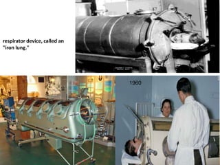 1960
respirator device, called an
"iron lung."
14
 