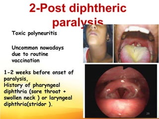 2-Post diphtheric
paralysis
Toxic polyneuritis
Uncommon nowadays
due to routine
vaccination
1-2 weeks before onset of
paralysis,
History of pharyngeal
diphthria (sore throat +
swollen neck ) or laryngeal
diphthria(stridor ).
29
 