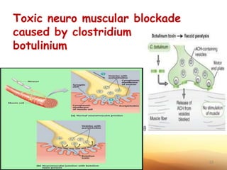 Toxic neuro muscular blockade
caused by clostridium
botulinium
33
 
