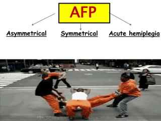 Asymmetrical Symmetrical Acute hemiplegia
5
AFP
 
