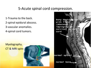 5-Acute spinal cord compression.
1-Trauma to the back.
2-spinal epidural abscess.
3-vascular anomalies.
4-spinal cord tumors.
Myelography.
CT & MRI spine
42
 