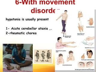 6-With movement
disorder
hypotonia is usually present
1- Acute cerebellar ataxia ,.
2-rheumatic chorea
43
 