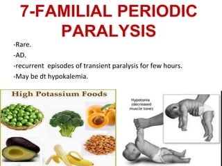 7-FAMILIAL PERIODIC
PARALYSIS
-Rare.
-AD.
-recurrent episodes of transient paralysis for few hours.
-May be dt hypokalemia.
44
 