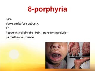 8-porphyria
Rare
Very rare before puberty.
AD.
Recurrent colicky abd. Pain.+transient paralysis.+
painful tender muscle.
45
 